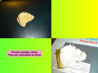 Pernos colados, listos Para ser colocados en boca 