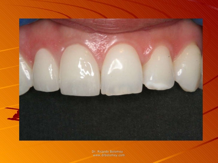 disadvantages of cerec crowns