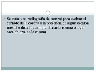  Se toma una radiografia de control para evaluar el
cerrado de la corona o la presencia de algun escalon
mesial o distal que impida bajar la corona o algun
area abierta de la corona
 