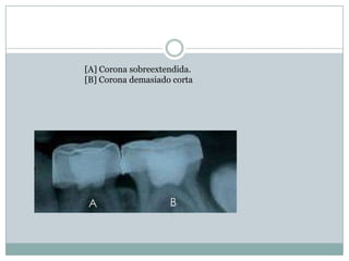 [A] Corona sobreextendida.
[B] Corona demasiado corta
 