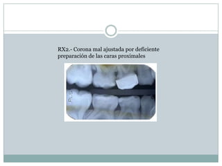 RX2.- Corona mal ajustada por deficiente
preparación de las caras proximales
 