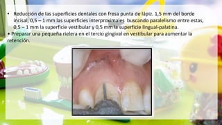• Reducción de las superficies dentales con fresa punta de lápiz. 1,5 mm del borde
incisal, 0,5 – 1 mm las superficies interproximales buscando paralelismo entre estas,
0,5 – 1 mm la superficie vestibular y 0,5 mm la superficie lingual-palatina.
• Preparar una pequeña rielera en el tercio gingival en vestibular para aumentar la
retención.
 