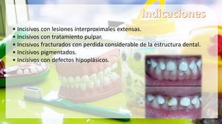 • Incisivos con lesiones interproximales extensas.
• Incisivos con tratamiento pulpar.
• Incisivos fracturados con perdida considerable de la estructura dental.
• Incisivos pigmentados.
• Incisivos con defectos hipoplásicos.
 