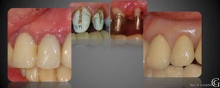 PRE
Técn. R. Schaeffer