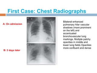 First Case: Chest Radiographs
Bilateral enhanced
pulmonary hilar vascular
shadows (more prominent
on the left) and
accentuated
bronchovascular lung
markings. Multiple patchy
opacities in middle and
lower lung fields Opacities
more confluent and dense
A: On admission
B: 2 days later
 