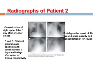 Radiographs of Patient 2
B. 4 days after onset of illn
Ground glass opacity and
consolidation of left lower l
. Consolidation of
right upper lobe, 1
day after onset of
illness
C and D. Bilateral
ground-glass
opacities and
consolidation, 7
days and 9 days
after onset of
illness, respectively
 