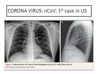 CORONA VIRUS: nCoV: 1st case in US
 