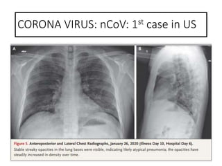 CORONA VIRUS: nCoV: 1st case in US
 