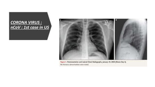 CORONA VIRUS :
nCoV : 1st case in US
 