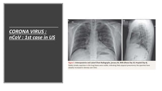 CORONA VIRUS :
nCoV : 1st case in US
 