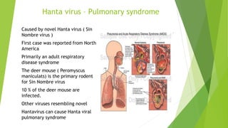 Hanta virus – Pulmonary syndrome
Caused by novel Hanta virus ( Sin
Nombre virus )
First case was reported from North
America
Primarily an adult respiratory
disease syndrome
The deer mouse ( Peromyscus
maniculats) is the primary rodent
for Sin Nombre virus
10 % of the deer mouse are
infected.
Other viruses resembling novel
Hantavirus can cause Hanta viral
pulmonary syndrome
 