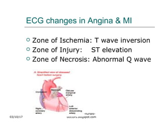 ECG changes in Angina & MI
 Zone of Ischemia: T wave inversion
 Zone of Injury: ST elevation
 Zone of Necrosis: Abnormal Q wave
03/10/17
www.health-nurses-
doctors.blogspot.com
 