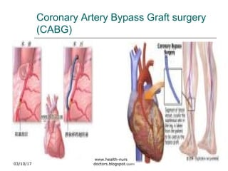 Coronary Artery Bypass Graft surgery
(CABG)
03/10/17
www.health-nurses-
doctors.blogspot.com
 
