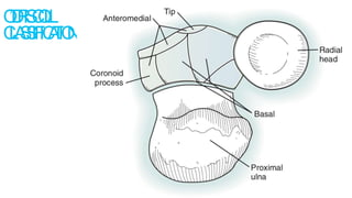 Coronoid Classification Coronoid fracture | PPTX
