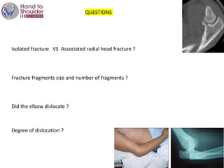 QUESTIONS
Isolated fracture VS Associated radial head fracture ?
Fracture fragments size and number of fragments ?
Did the elbow dislocate ?
Degree of dislocation ?
 
