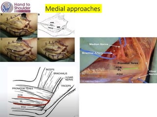 Medial approaches
 