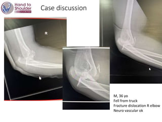 Case discussion
M, 36 yo
Fell from truck
Fracture dislocation R elbow
Neuro vascular ok
 