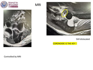 MRI
Still dislocated
CORONOIDE IS THE KEY !
Controlled by MRI
 