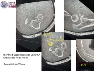 PLRI
Controlled by CT Scan
They tried second reduction under GA
And planned for EX FIX !!!
 