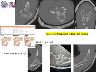 What do you do ?
Anteromedial type II, 3
You receive this patient 3 days after trauma
 