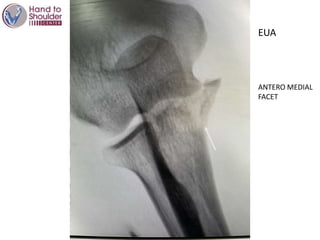 EUA
ANTERO MEDIAL
FACET
 