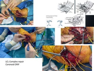 LCL Complex repair
Coronoid ORIF
 