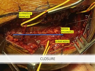 CLOSURE
ULNAR NERVE
CUTANEOUS
BRANCHES
MEDIAL
EPICONDYLE
 
