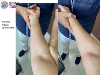 Stabilty
Result
@3 months
 