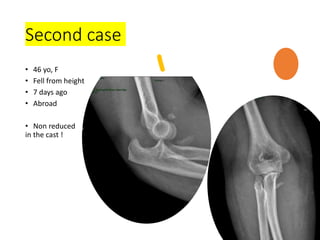 Second case
• 46 yo, F
• Fell from height
• 7 days ago
• Abroad
• Non reduced
in the cast !
 