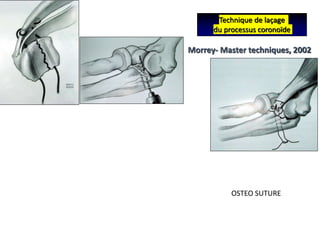 Technique de laçage
du processus coronoïde
Morrey- Master techniques, 2002
OSTEO SUTURE
 
