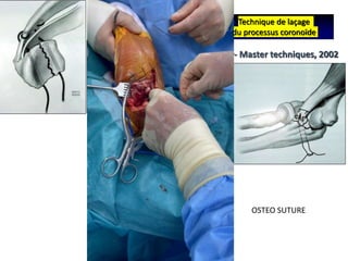 Technique de laçage
du processus coronoïde
Morrey- Master techniques, 2002
OSTEO SUTURE
 