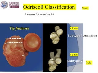 Odriscoll Classification Type I
Often isolated
PLRI
< 2 mm
> 2 mm
Transverse fracture of the TIP
 
