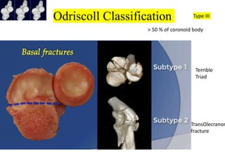 Odriscoll Classification Type III
TransOlecranon
fracture
> 50 % of coronoid body
Terrible
Triad
 