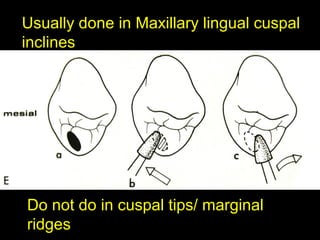 Cuspal Ridges Coronoplasty | PPT