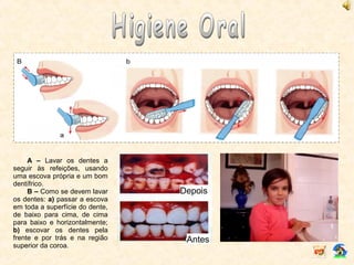 A – Lavar os dentes a
seguir às refeições, usando
uma escova própria e um bom
dentífrico.
B – Como se devem lavar
os dentes: a) passar a escova
em toda a superfície do dente,
de baixo para cima, de cima
para baixo e horizontalmente;
b) escovar os dentes pela
frente e por trás e na região
superior da coroa.
Depois
Antes
 