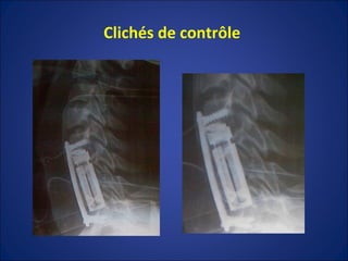 Clichés de contrôle  