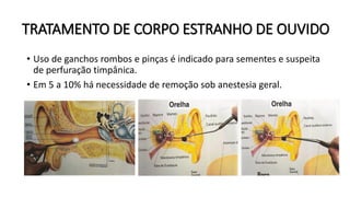 TRATAMENTO DE CORPO ESTRANHO DE OUVIDO
• Uso de ganchos rombos e pinças é indicado para sementes e suspeita
de perfuração timpânica.
• Em 5 a 10% há necessidade de remoção sob anestesia geral.
 