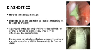 DIAGNOSTICO
• História clínica e exame físico;
• Depende do objeto aspirado, do local de impactação e
da idade da criança;
• Alguns pacientes podem permanecer assintomáticos,
levando a atraso no diagnóstico, pneumonias,
enfisemas e bronquiectasias;
• Em crianças conscientes, é facilmente reconhecido por
angústia respiratória súbita, incapacidade de falar ou
tossir;
 