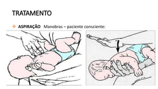 TRATAMENTO
 ASPIRAÇÃO Manobras – paciente consciente:
 