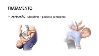TRATAMENTO
 ASPIRAÇÃO Manobras – paciente consciente:
 