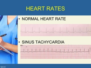 HEART RATES
• NORMAL HEART RATE




• SINUS TACHYCARDIA
 
