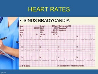 HEART RATES
• SINUS BRADYCARDIA
 