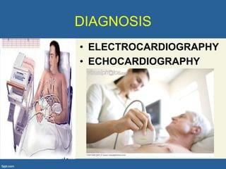 DIAGNOSIS
• ELECTROCARDIOGRAPHY
• ECHOCARDIOGRAPHY
 