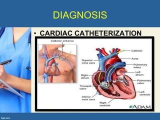 DIAGNOSIS
• CARDIAC CATHETERIZATION
 