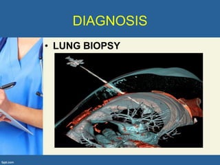 DIAGNOSIS
• LUNG BIOPSY
 