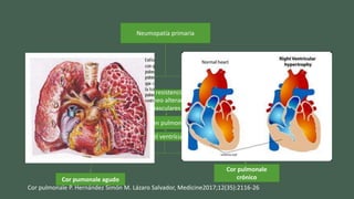 Neumopatía primaria
Aguda Crónica
Aumento resistencia al flujo
sanguíneo alteraciones
vasculares
Hipertensión pulmonar arterial
Crecimiento el ventrículo derecho
Por dilatación Por hipertrofia
Cor pumonale agudo
Cor pulmonale
crónico
Cor pulmonale P. Hernández Simón M. Lázaro Salvador, Medicine2017;12(35):2116-26
 