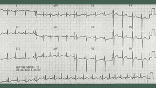 Diagnóstico. Pruebas complementarias
• La sensibilidad del electrocardiograma para el diagnóstico de CP es
del 20 al 40%, mientras que la especificidad de signos de hipertrofia
del ventrículo derecho es mayor.
Cor pulmonale P. Hernández Simón M. Lázaro Salvador, Medicine2017;12(35):2116-26
 