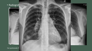 • Radiografía en proyección postero-anterior y lateral dado que
permite observar datos sugestivos de enfermedad pulmonar
como origen de la hipertensión pulmonar y evaluar
crecimiento ventricular derecho.
Cor pulmonale P. Hernández Simón M. Lázaro Salvador, Medicine2017;12(35):2116-26
 