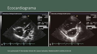 Ecocardiograma
• Aumento el grosor parietal del VD
• Movimiento paradójico del septo hacia ventrículo izquierdo
• Crecimiento el VD
• Detectar la etiología
Cor pulmonale P. Hernández Simón M. Lázaro Salvador, Medicine2017;12(35):2116-26
 