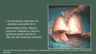 • El transplante pulmonar en
estadios avanzados de la
enfermedad (EPOC, fibrosis
pulmonar idiopática y fibrosis
quiística) puede revertir la
afección del ventrículo derecho.
GUIA DE PRACTICA CLINICA 2017 DIAGNOSTICO Y TRATAMIENTO DE COR PULMONALE EN EL SEGUNDO Y TERCER NIVEL DE
ATENCION
 